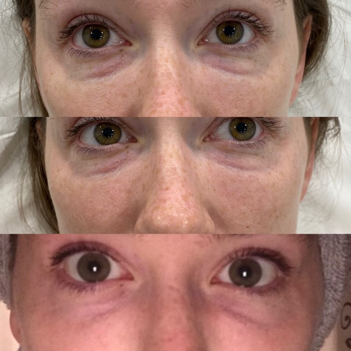 Before and After Eyebag V3