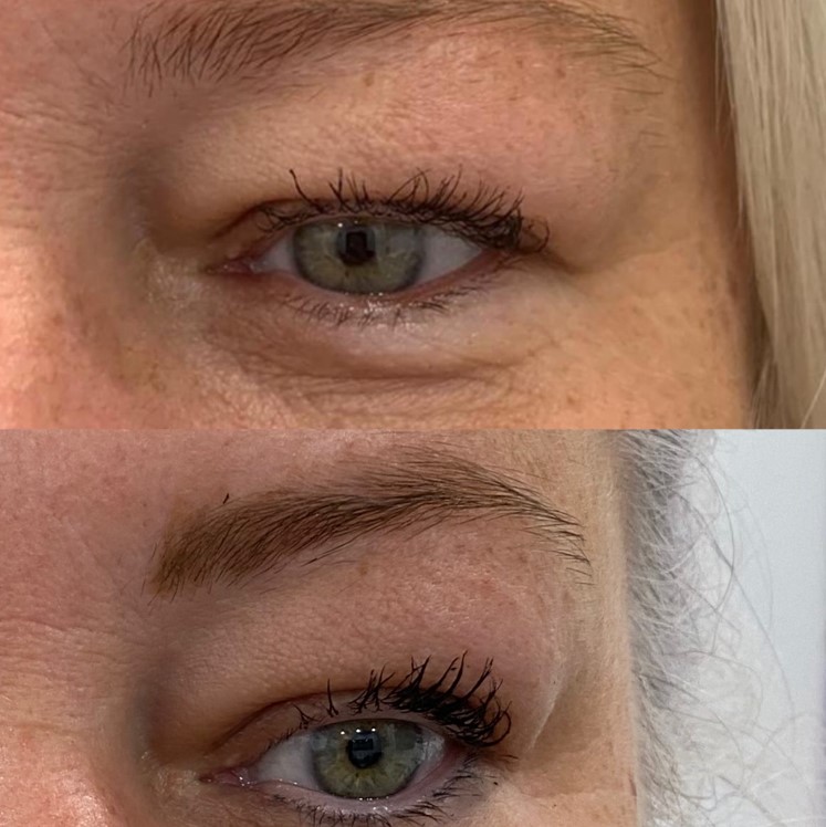 Before and After Eyebag V4