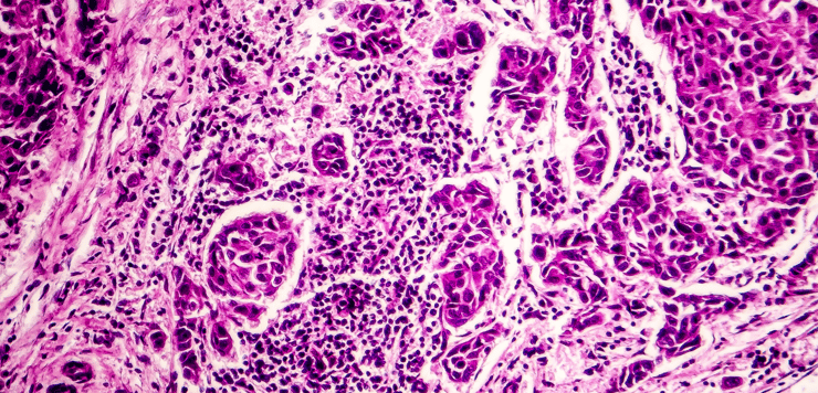 LymphaTouch in Treating Longstanding Fibrosis in Chronic Lymphoedema