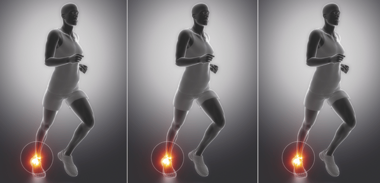Shock! Our Turn for a Webinar on Shockwave for Achilles Tendinopathy