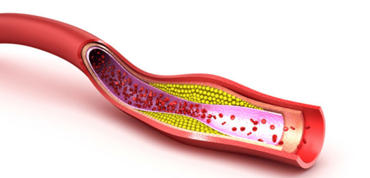 PiezoWave2 for the Treatment of Vascular ED